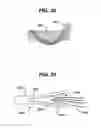Fig. 20 - Knotless suture anchor with unthreaded nose