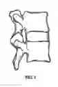 Fig. 03 - System and method for replacement of spinal motion segment