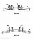 Fig. 08 - System and method for replacement of spinal motion segment