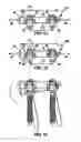 Fig. 10 - System and method for replacement of spinal motion segment