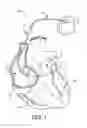 Fig. 02 - Lead conductor with pitch and torque control for MRI conditionally safe use