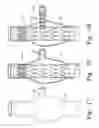 Fig. 16 - Fenestrated intraluminal stent system