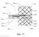 Fig. 14 - Proximal release delivery system