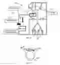 Fig. 07 - Correction and optimization of wave reflection in blood vessels