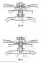Fig. 07 - METHOD AND SYSTEM OF DEVICES FOR PERMANENT ACCESS TO THE CIRCULATORY SYSTEM FOR CHRONIC HEMODIALYSIS