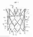 Fig. 02 - Repositioning of prosthetic heart valve and deployment