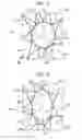 Fig. 06 - Repositioning of prosthetic heart valve and deployment
