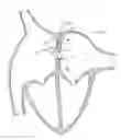 Fig. 01 - Prosthesis for reducing intra-cardiac pressure having an embolic filter