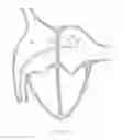 Fig. 13 - Prosthesis for reducing intra-cardiac pressure having an embolic filter