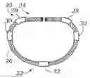 Fig. 01 - Flexible annuloplasty ring with select control points