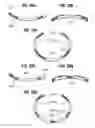 Fig. 09 - Flexible annuloplasty ring with select control points