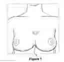 Fig. 02 - IMPLANTABLE PROSTHESIS FOR POSITIONING AND SUPPORTING A BREAST IMPLANT