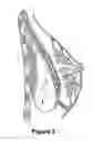 Fig. 03 - IMPLANTABLE PROSTHESIS FOR POSITIONING AND SUPPORTING A BREAST IMPLANT