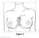 Fig. 04 - IMPLANTABLE PROSTHESIS FOR POSITIONING AND SUPPORTING A BREAST IMPLANT
