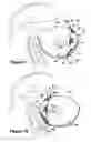 Fig. 08 - IMPLANTABLE PROSTHESIS FOR POSITIONING AND SUPPORTING A BREAST IMPLANT