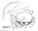Fig. 09 - IMPLANTABLE PROSTHESIS FOR POSITIONING AND SUPPORTING A BREAST IMPLANT
