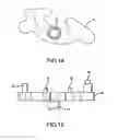 Fig. 05 - Retaining member for a joint prosthesis
