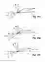 Fig. 10 - Wind turbine blade provided with flow altering devices