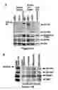 Fig. 03 - Method for diagnosing  acute lymphomic leukemia (ALL) using miR-125b