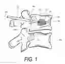 Fig. 02 - Bone treatment systems and methods