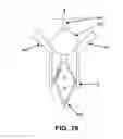 Fig. 75 - KNOTLESS SUTURE ANCHOR FOR SECURING SOFT TISSUE TO BONE