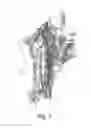 Fig. 02 - Endovascular electrostimulation near a carotid bifurcation in treating cerebrovascular conditions