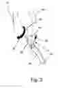 Fig. 04 - Endovascular electrostimulation near a carotid bifurcation in treating cerebrovascular conditions