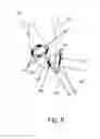 Fig. 07 - Endovascular electrostimulation near a carotid bifurcation in treating cerebrovascular conditions