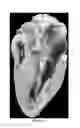 Fig. 02 - Treating congestive heart failure