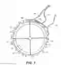 Fig. 04 - Intraocular implants and related kits and methods