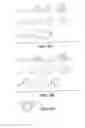 Fig. 07 - Intraocular implants and related kits and methods