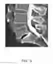 Fig. 06 - Spinal Fusion Cage, Method of Design, and Method of Use