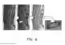 Fig. 07 - Spinal Fusion Cage, Method of Design, and Method of Use