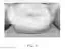 Fig. 08 - Spinal Fusion Cage, Method of Design, and Method of Use