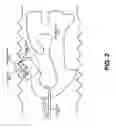 Fig. 03 - Adjusting a position of a heating wire within a breathing circuit
