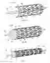 Fig. 04 - Two-stage method of compressing a stent