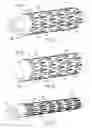 Fig. 06 - Two-stage method of compressing a stent