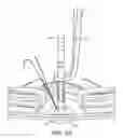 Fig. 20 - Method and apparatus for forming stoma trephines and anastomoses