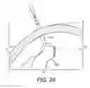Fig. 22 - Method and apparatus for forming stoma trephines and anastomoses