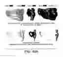 Fig. 45 - METHODS AND SYSTEMS FOR PRODUCING AN IMPLANT
