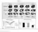 Fig. 09 - Efficient Generation of Neurally-Induced Mesenchymal Stem Cells and Applications Thereof