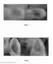 Fig. 02 - METHOD OF TREATING ECZEMA