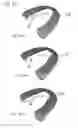 Fig. 12 - IMPRESSION TRAY, AND METHOD FOR CAPTURING STRUCTURES, ARRANGEMENTS OR SHAPES, IN PARTICULAR IN THE MOUTH OR HUMAN BODY