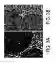 Fig. 04 - Kits for and methods of differential staining of cervical cancer cells and/or tissues