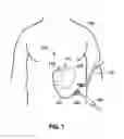 Fig. 02 - IMPLANTABLE ACCESS PORT SYSTEM
