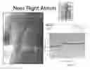 Fig. 178 - DETERMINATION OF BLOOD PUMP SYSTEM PERFORMANCE AND SAMPLE DILUTION USING A PROPERTY OF FLUID BEING TRANSPORTED
