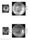 Fig. 08 - Macro/micro duty cycle devices, systems, and methods employing low-frequency ultrasound or other cyclical pressure energies