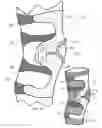 Fig. 02 - ORTHOTIC WITH LIMITED MIGRATION