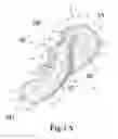 Fig. 02 - Hand held orthosis having a flexible enclosure and method of utilization