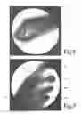 Fig. 09 - Hand held orthosis having a flexible enclosure and method of utilization